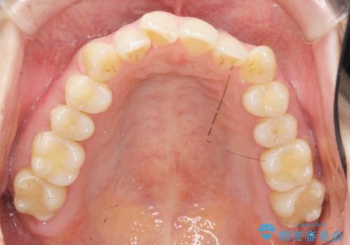 前歯のねじれを改善 マウスピース矯正インビザラインの治療前