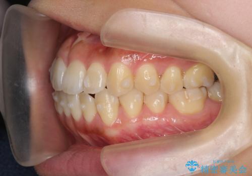 [ 前歯開咬 ]   前歯が噛んでいない マウスピース矯正治療の治療中