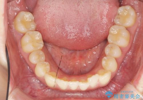 前歯のねじれを改善 マウスピース矯正インビザラインの治療前