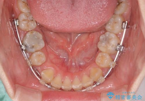 目立たない装置で出っ歯を治したい ハーフリンガル矯正の治療中