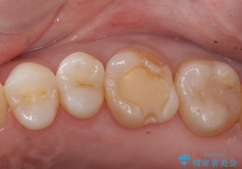 検診で虫歯を発見。の治療中