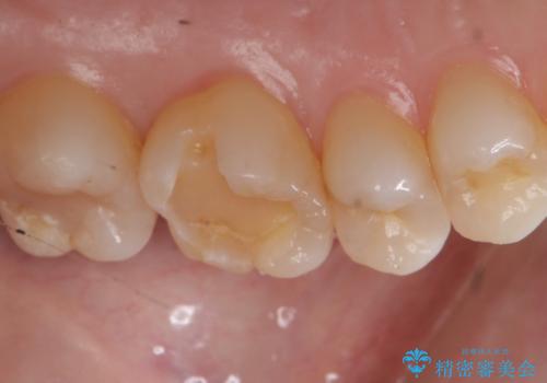 検診で虫歯を発見。の治療中