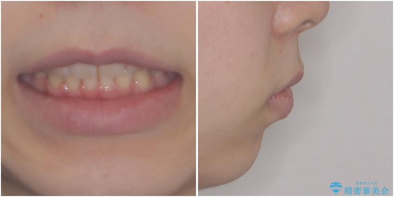 目立たない装置で出っ歯を治したい ハーフリンガル矯正の治療後(顔貌)