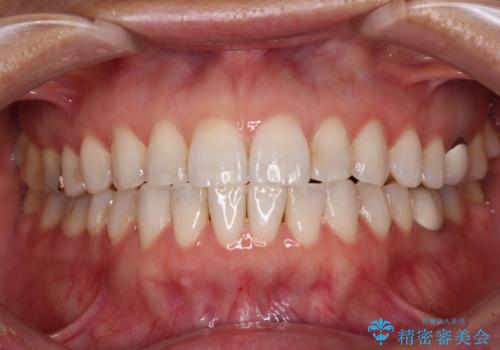 ちょっとしたデコボコをしっかりと改善したい インビザライン矯正の症例 治療後