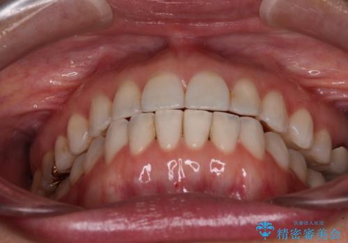 ちょっとしたデコボコをしっかりと改善したい インビザライン矯正の治療後