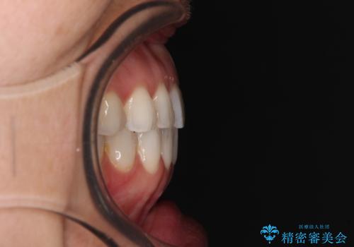 ちょっとしたデコボコをしっかりと改善したい インビザライン矯正の治療後