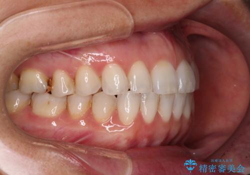 ちょっとしたデコボコをしっかりと改善したい インビザライン矯正の治療後