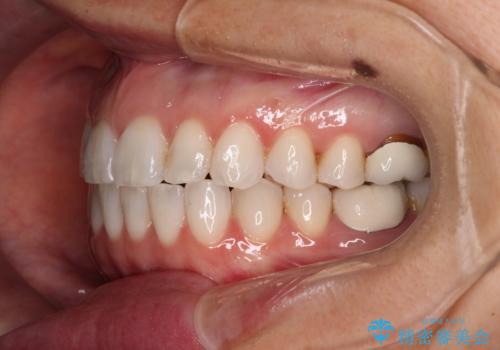 ちょっとしたデコボコをしっかりと改善したい インビザライン矯正の治療後