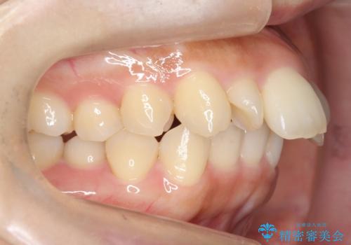 前歯がでている　最小限の抜歯で口を閉じやすくの症例 治療前