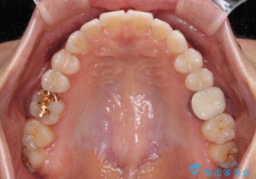 ちょっとしたデコボコをしっかりと改善したい インビザライン矯正の治療後