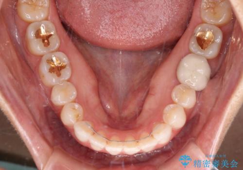 ちょっとしたデコボコをしっかりと改善したい インビザライン矯正の治療後