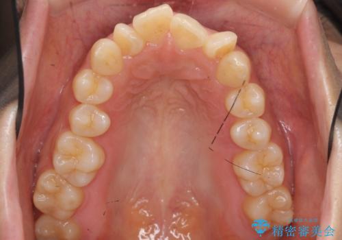前歯がでている　最小限の抜歯で口を閉じやすくの治療前
