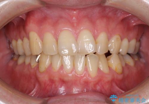 欠損のある歯列　インビザラインで整った歯並びにの治療前