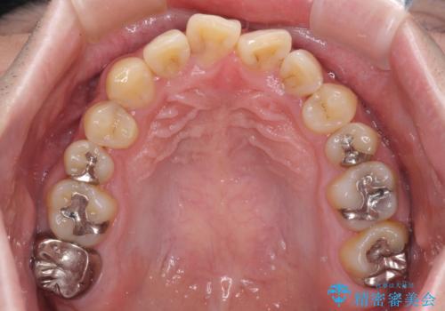欠損のある歯列　インビザラインで整った歯並びにの治療前