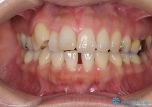 閉じにく口元と欠損歯列　ワイヤー装置の抜歯矯正の症例 治療前