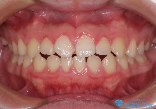舌突出癖で隙間の空いてしまう歯列　舌トレーニングを行ったインビザライン矯正の症例 治療前