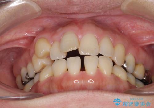 閉じにく口元と欠損歯列 ワイヤー装置の抜歯矯正の治療前