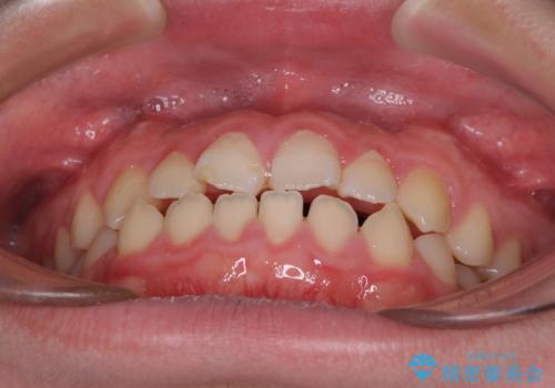 舌突出癖で隙間の空いてしまう歯列　舌トレーニングを行ったインビザライン矯正の治療前