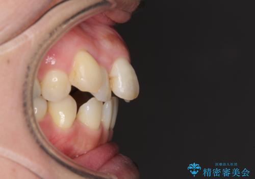 閉じにく口元と欠損歯列　ワイヤー装置の抜歯矯正の治療前