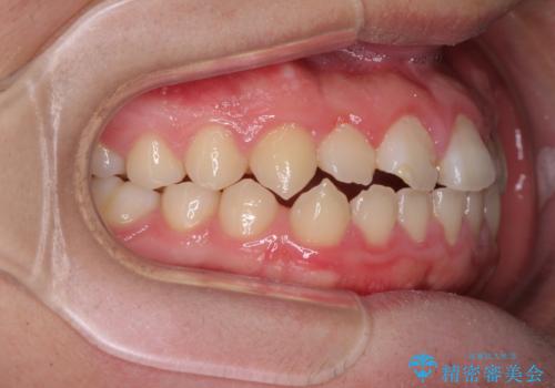 舌突出癖で隙間の空いてしまう歯列　舌トレーニングを行ったインビザライン矯正の治療前