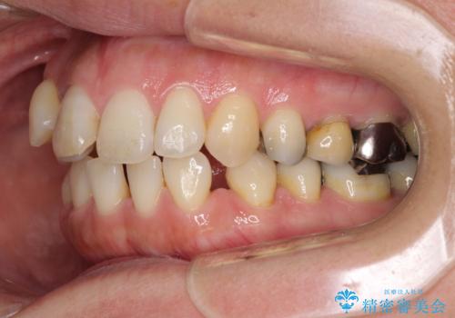 閉じにく口元と欠損歯列 ワイヤー装置の抜歯矯正の治療前