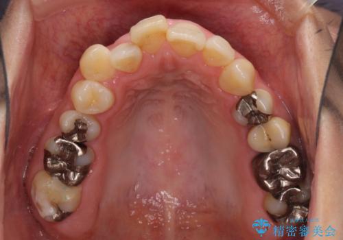閉じにく口元と欠損歯列　ワイヤー装置の抜歯矯正の治療前