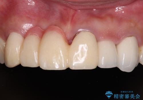 長く見える歯を治したい　歯肉移植による歯肉増大術の症例 治療前