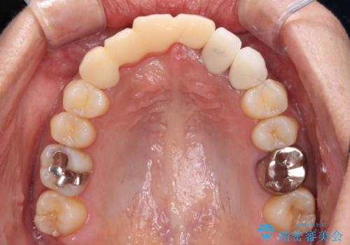 長く見える歯を治したい　歯肉移植による歯肉増大術の治療前