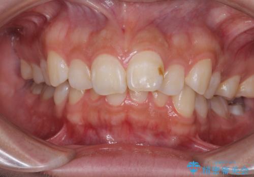 上顎前突による口元の突出感　強く深い咬合をワイヤー矯正で改善していくの症例 治療前