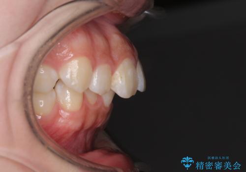 上顎前突による口元の突出感　強く深い咬合をワイヤー矯正で改善していくの治療前