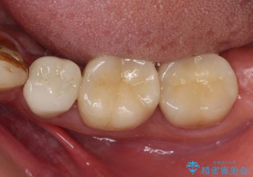 痛みの続く大きな虫歯の奥歯 オールセラミッククラウンでの補綴治療の治療後