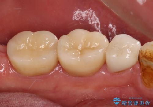 痛みの続く大きな虫歯の奥歯 オールセラミッククラウンでの補綴治療の治療後