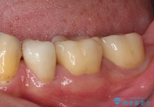 痛みの続く大きな虫歯の奥歯　オールセラミッククラウンでの補綴治療