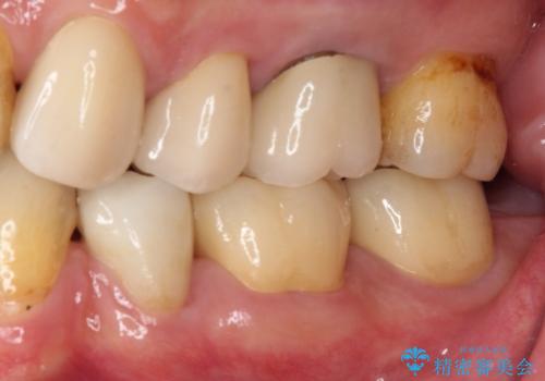 痛みの続く大きな虫歯の奥歯 オールセラミッククラウンでの補綴治療の治療後