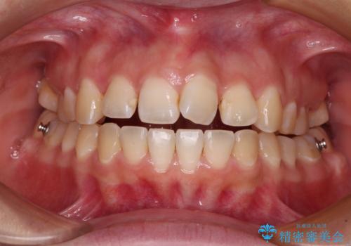 【モニター】カリエールディスタライザーとインビザラインを用いた奥歯の咬み合わせ改善の治療中