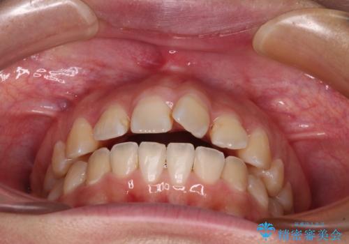 【モニター】カリエールディスタライザーとインビザラインを用いた奥歯の咬み合わせ改善の治療中