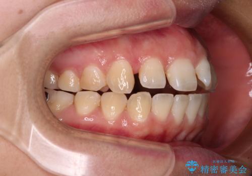 【モニター】カリエールディスタライザーとインビザラインを用いた奥歯の咬み合わせ改善の治療中