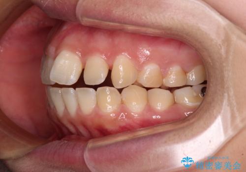 【モニター】カリエールディスタライザーとインビザラインを用いた奥歯の咬み合わせ改善の治療中