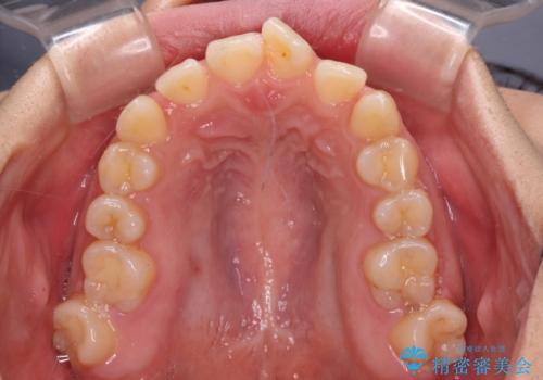 【モニター】カリエールディスタライザーとインビザラインを用いた奥歯の咬み合わせ改善の治療中