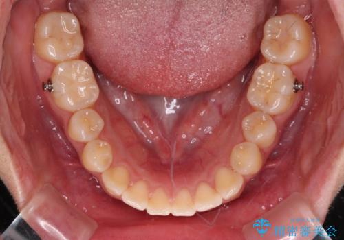 【モニター】カリエールディスタライザーとインビザラインを用いた奥歯の咬み合わせ改善の治療中