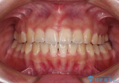 【モニター】カリエールディスタライザーとインビザラインを用いた奥歯の咬み合わせ改善の症例 治療後
