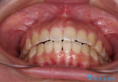 【モニター】カリエールディスタライザーとインビザラインを用いた奥歯の咬み合わせ改善の治療後