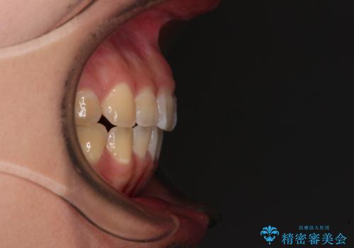 【モニター】カリエールディスタライザーとインビザラインを用いた奥歯の咬み合わせ改善の治療後