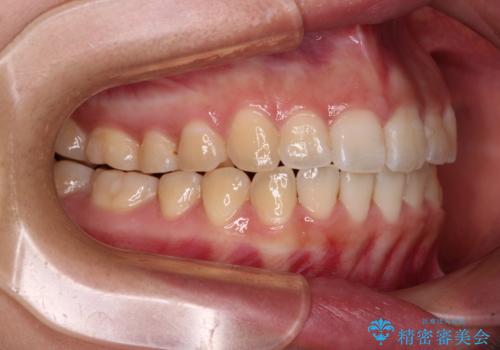 【モニター】カリエールディスタライザーとインビザラインを用いた奥歯の咬み合わせ改善の治療後