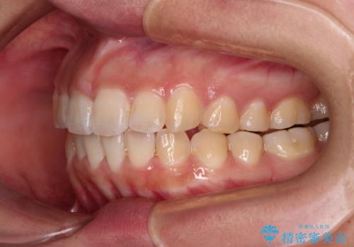 【モニター】カリエールディスタライザーとインビザラインを用いた奥歯の咬み合わせ改善の治療後