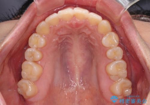 【モニター】カリエールディスタライザーとインビザラインを用いた奥歯の咬み合わせ改善の治療後