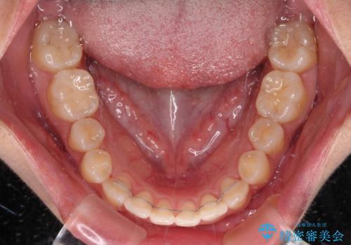 【モニター】カリエールディスタライザーとインビザラインを用いた奥歯の咬み合わせ改善の治療後