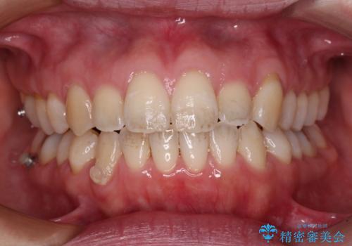 受け口傾向の歯並びをインビザラインで改善の治療中