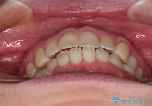 受け口傾向の歯並びをインビザラインで改善の治療中