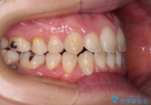 受け口傾向の歯並びをインビザラインで改善の治療中